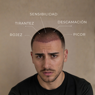 Síntomas habituales tras un injerto capilar: rojez, picor, tirantez, descamación y sensibilidad del cuero cabelludo.